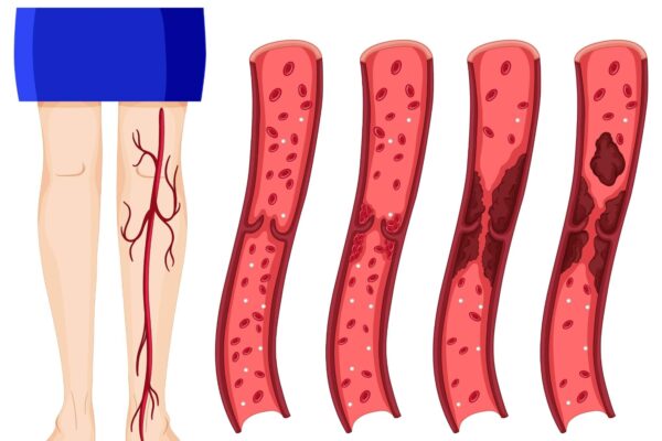 Roken risico trombose